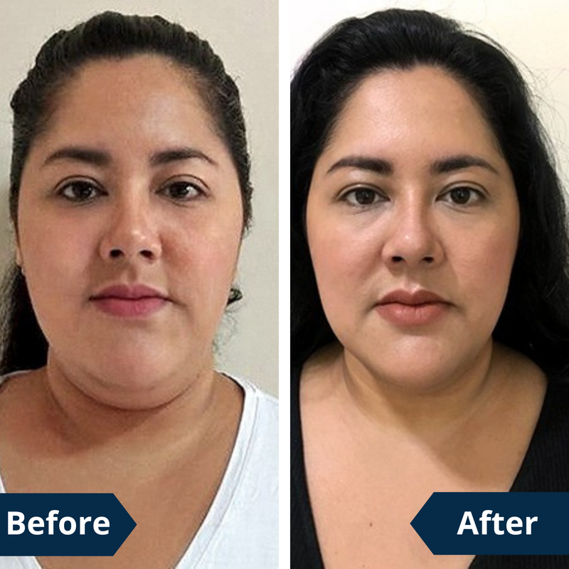 FaceLift™ – Reduce Double Chin, Lift Your Look