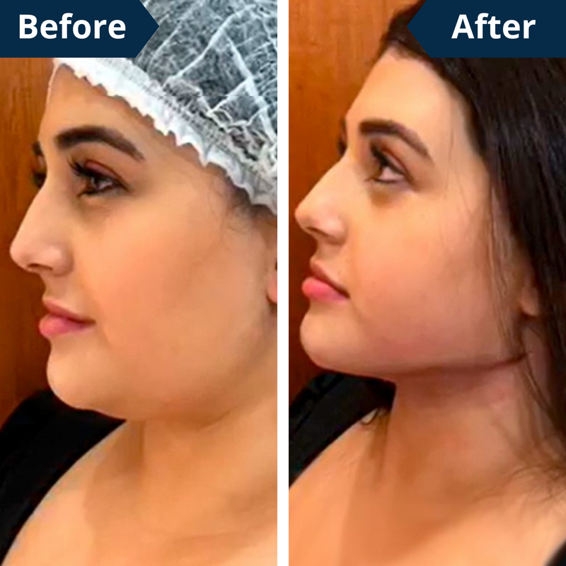 FaceLift™ – Reduce Double Chin, Lift Your Look