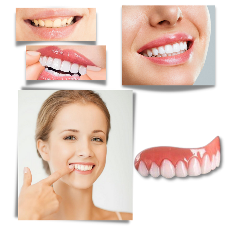 Snap-On Veneer Teeth